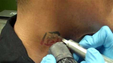 Laser Tattoo Removal Blackred Ink Youtube