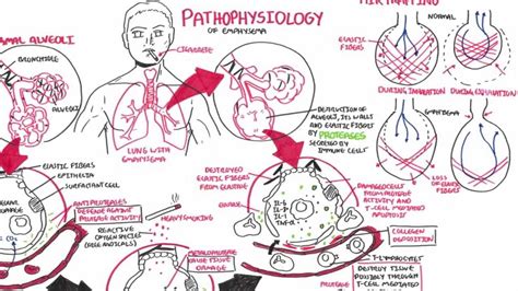 Pathophysiology Concept Map Emphysema Pathophysiology Nursing Images
