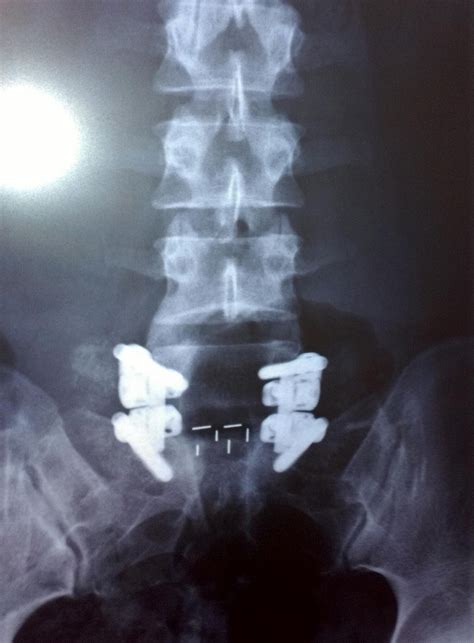 My L5 S1 Spinal Fusion 1st Set Of X Rays Second Post Op Visit W