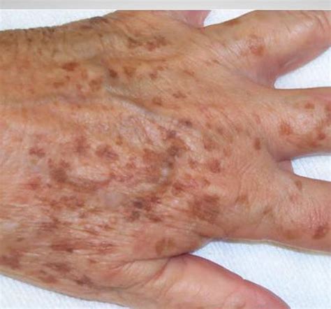 Age Spots On Hands And What Causes Them Liver Spot Age Spot Removal