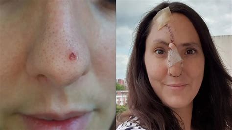 Mom Loses Tip Of Nose After Dismissing Skin Cancer Symptom As Pimple