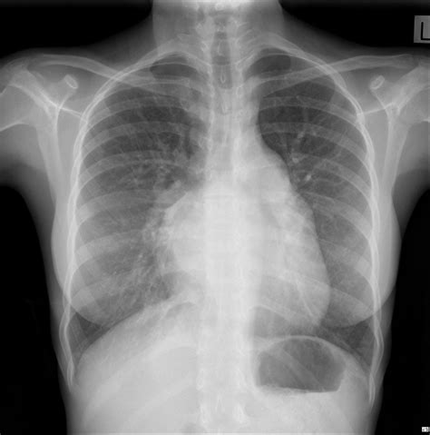 Mitral Heart Radiology Case Radiology Radiology