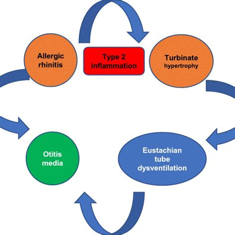 Turbinate Hypertrophy Allergic Rhinitis And Otitis Media Request Pdf