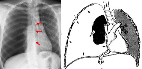 Pneumothorax develops when air enters the pleural space as the result of disease or injury. Pneumothorax spontané de l'adulte - Médecine d'urgence ...