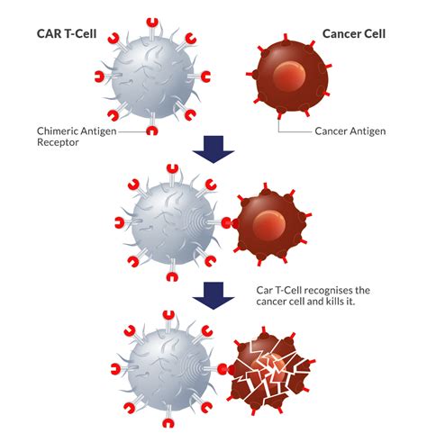 Car T Cell Therapy Cfch Centre For Clinical Haematology