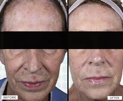 Laser Skin Resurfacing Treatment Guide Cost Side Effects And More