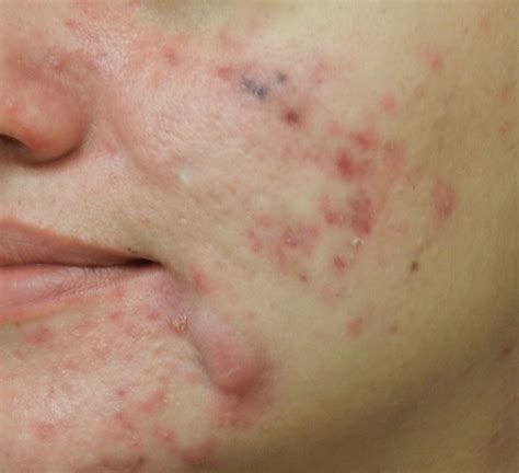 Saiba Mais Sobre Acne Cicatrizes De Acne E Os Devidos Cuidados