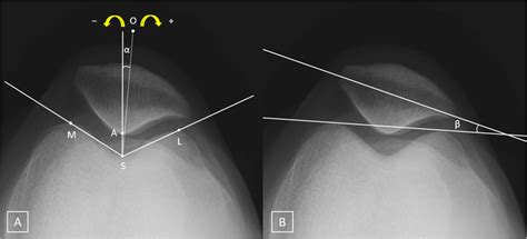 Measurement Of The Congruence And Patellar Tilt Angles On The Left Knee