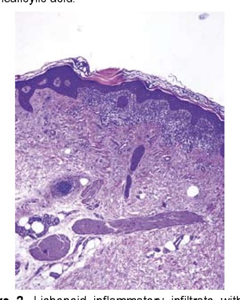 Figure 2 From Morphological Evidence Of Periodical Exacerbation Of