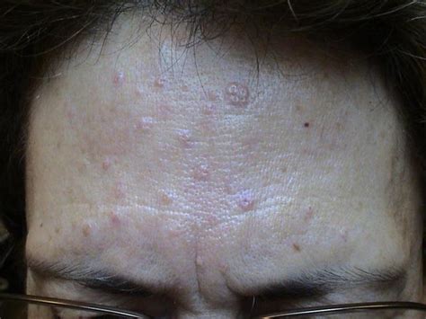 Benign Skin Lesions Nevi Cysts Sebaceous Naevus Pictu