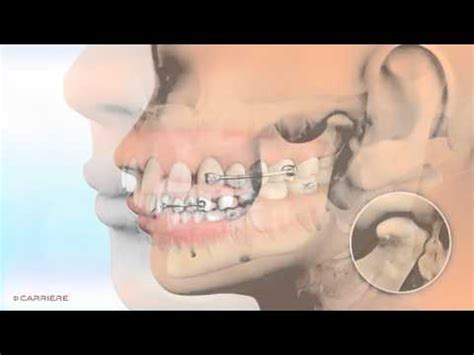 This is getting a lot of publicity, so i thought henry schein orthodontics market the carriere motion appliance. Carriere® Motion™ Appliance for Class II Patient Education ...