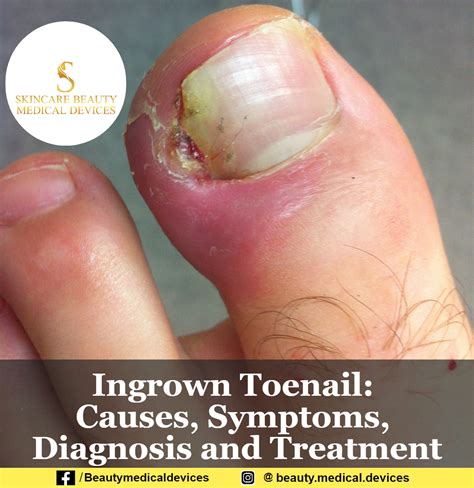 Ingrown Toenail Causes Symptoms Diagnosis And Treatment