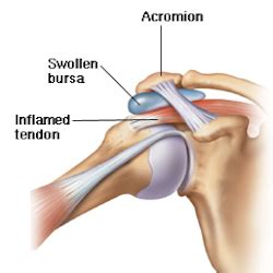 Shoulder Tendinitis Causes Treatment Cleveland Clinic Health Library