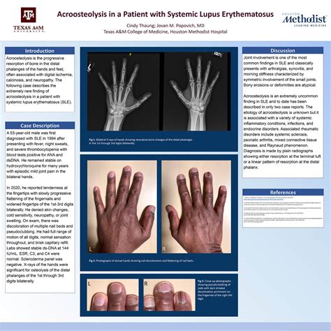 Nail Changes In Lupus Erythematosus Nail Ftempo