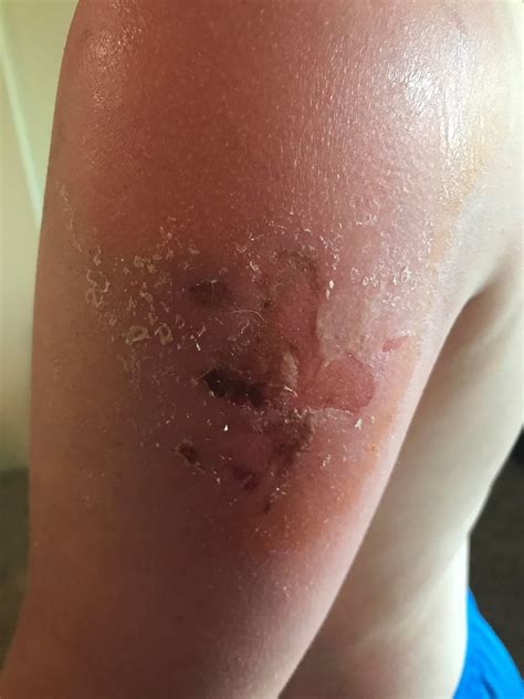 【ベストコレクション】 Sunburn Arm Sun Allergy Rash 201618 Gambarsaekkb