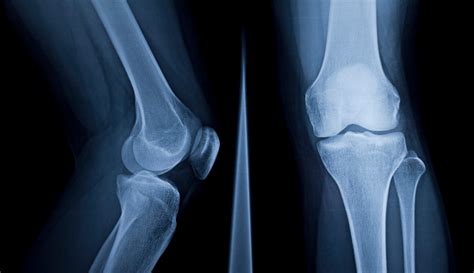 Medical Xray Normal Knee Bone High Resolution Image S