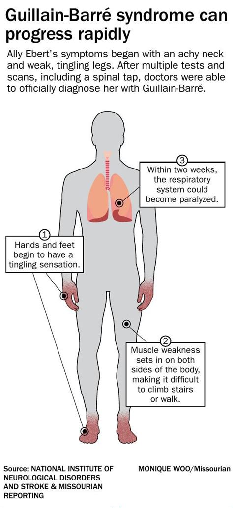 Symptoms often start in your feet and hands before. Guillain-Barre syndrome: What is it and why should you ...
