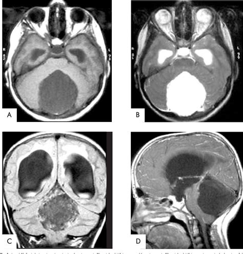 Figure 1 From Intraoperative Supratentorial Epidural Haematoma During
