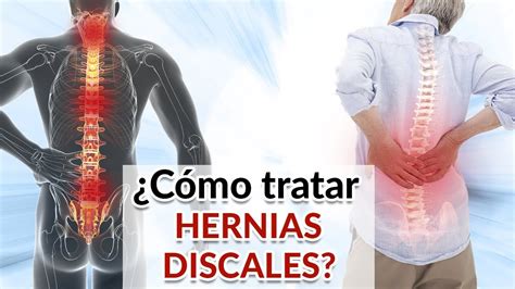 Hernia Discal Tratamiento Natural Y Recuperación Evita Cirugía Youtube