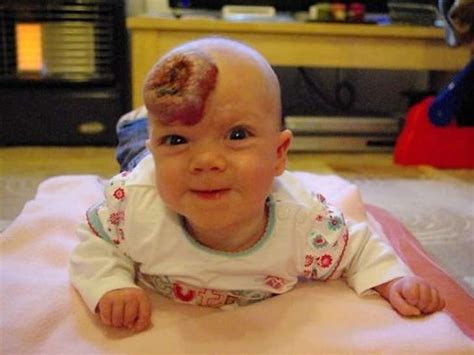 New Parents Shock As Babys Tiny Bruise On Forehead Grows Into