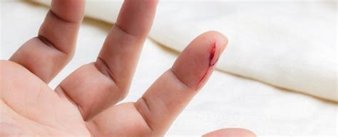 when do you need stitches renew physical therapy
