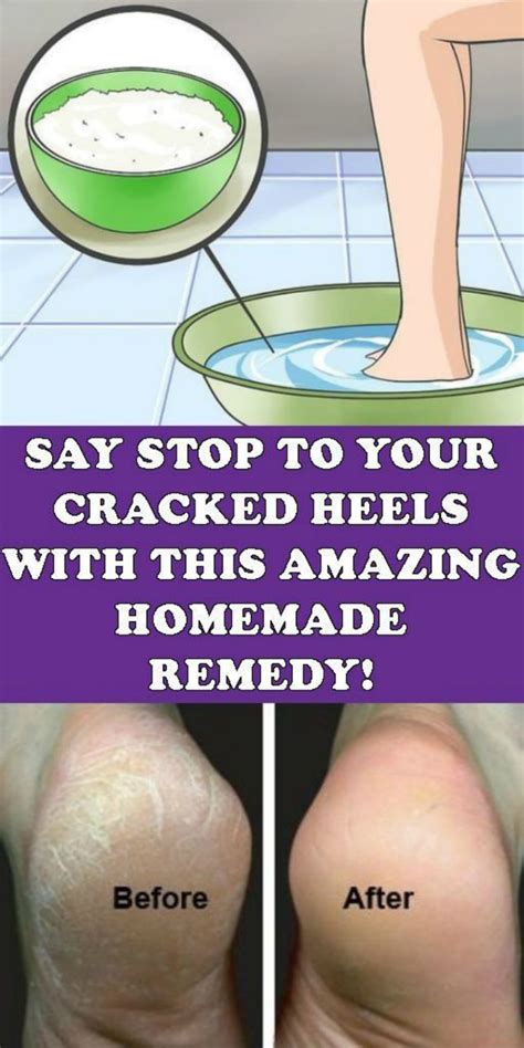 Say Stop To Your Cracked Heels With This Amazing Homemade Remedy Health And Fitnes