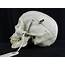 141 Pathological Human Skull