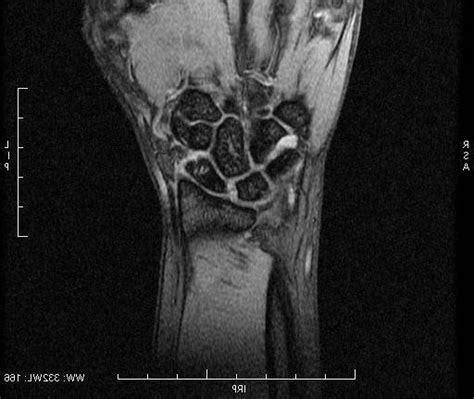 Coronal T2 Weighted Mri Right Wrist Joint Shows Low Signal Intensity