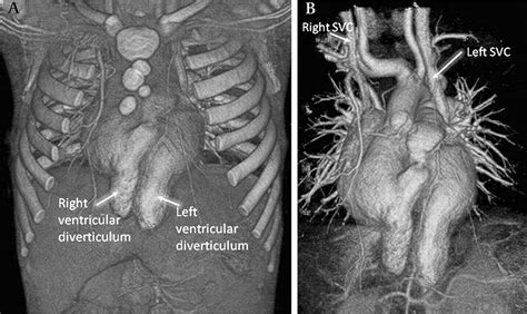 Ectopia Cordis With Right And Left Ventricular Diverticula Heart