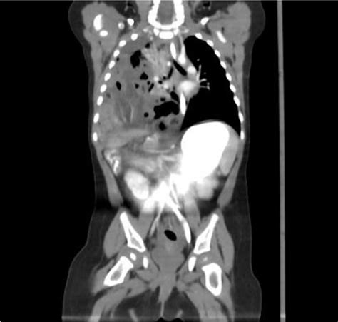 Figure 1 From Right Sided Bochdalek Diaphragmatic Hernia Appeared As A