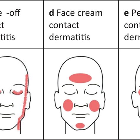 Common Clinical Patterns Of Face Contact Dermatitis A Airborne Contact