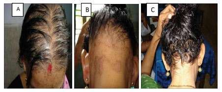 Hair loss is a condition which affects millions of people in the uk. Thyroxine: Zinc And Thyroxine
