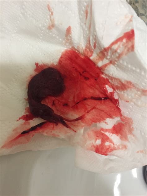 Blood clots in your period can be a very normal and natural part of your menstruation. Is this clot normal ? Sorry it's gross - Glow Community