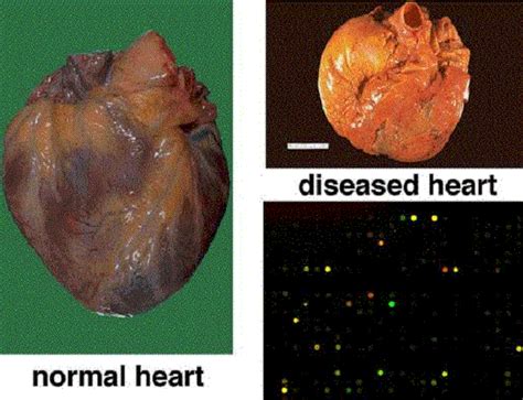 Diseased Human Heart Pictures Dengan Gambar