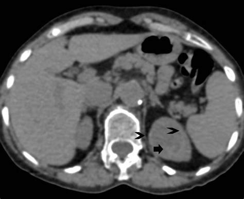 Collecting Duct Carcinoma Of The Kidney Atypical Imaging Findings