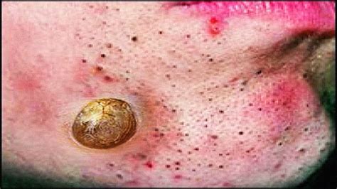 Check spelling or type a new query. Clogged Pores & Dermatology! - YouTube