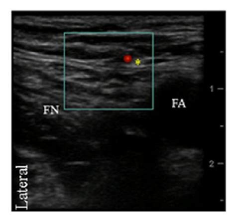 Transverse Ultrasound Image Of The Lateral Femoral Cutaneous Nerve