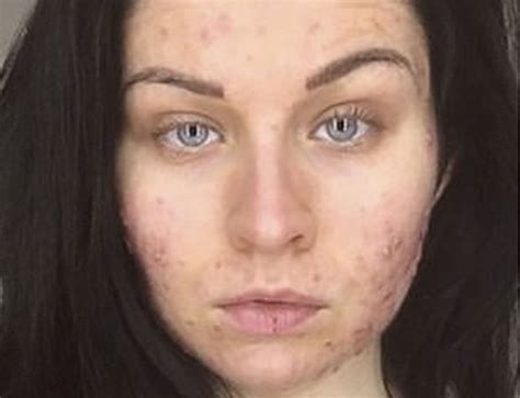 I Woke Up One Day With Severe Acne Bbc News