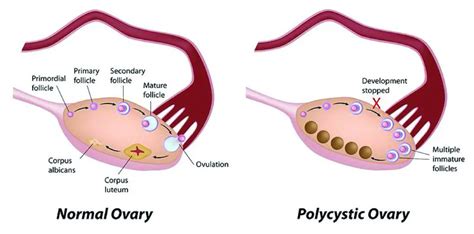 All You Need To Know About Polycystic Ovary Syndrome Pcos ⋆ The Costa