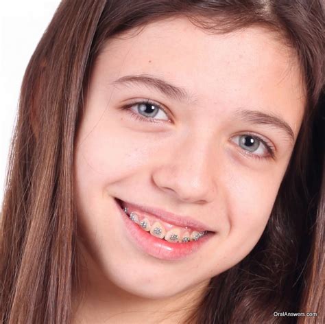 60 Photos Of Teenagers With Braces Oral Answers Braces Girls Cute