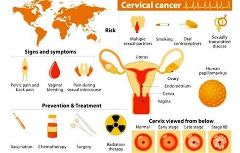 6 Types Of Cervical Cancer Treatment Cervical Cancer Treatment