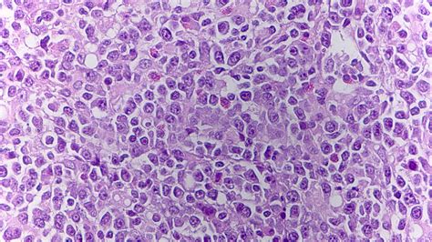 Pathology Outlines Plasmablastic Lymphoma