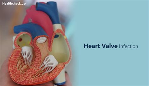 Heart Valve Infection Causes Symptoms And Treatment