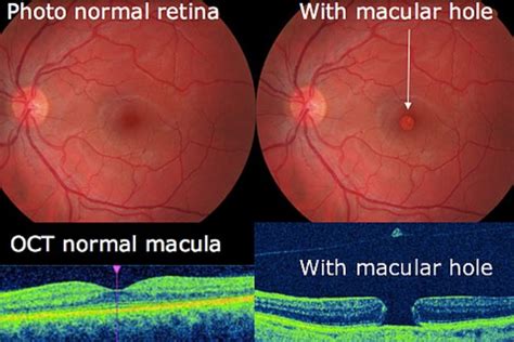 Macular Holes How They Are Formed And Repaired The Eye News