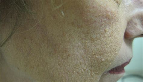 Papules On The Face And Body Mdedge Dermatology