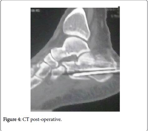 Clinical Research Foot Ankle Post Operative