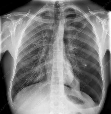 Pneumothorax X Ray Stock Image C017 7966 Science Photo Library