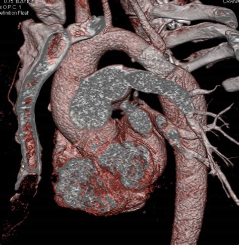 Coarctation Of The Aorta Repaired With Stent Vascular Case Studies