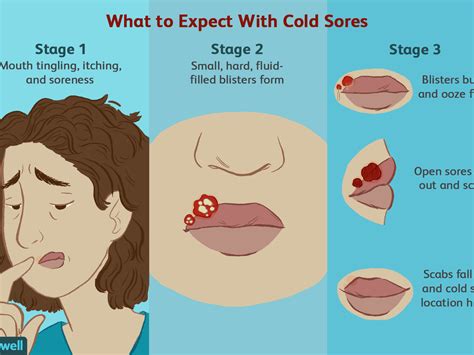 A cold should not last more than 2 weeks, though a cough can take longer to recover. How To Get Rid Of Yellow Scabs On Lips | Lipstutorial.org