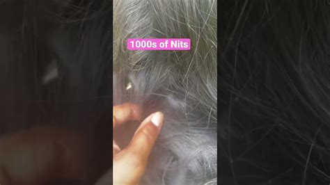 1000s Of Nits 😬 L Lice Removal Service 🐜 Stacey The Louse Lady Youtube